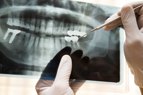 Panoramaaufnahme des Zahnsystems